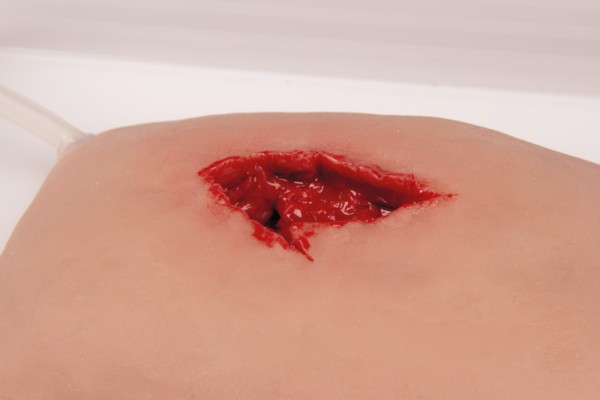 Wundmoulage wound packing